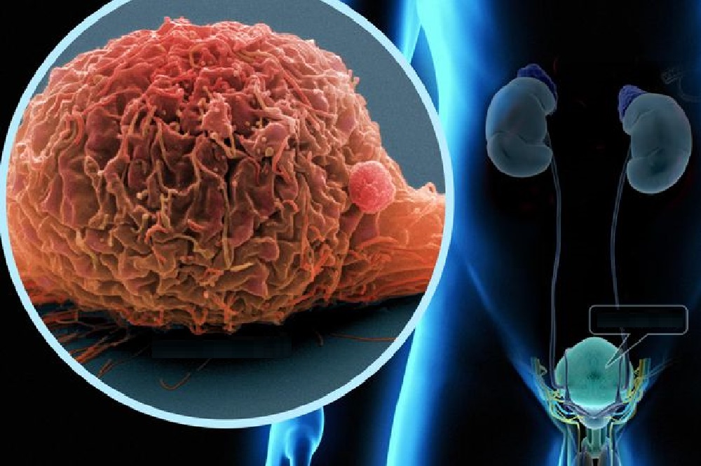 Bladder cancer kills 200,000 people in the world every year