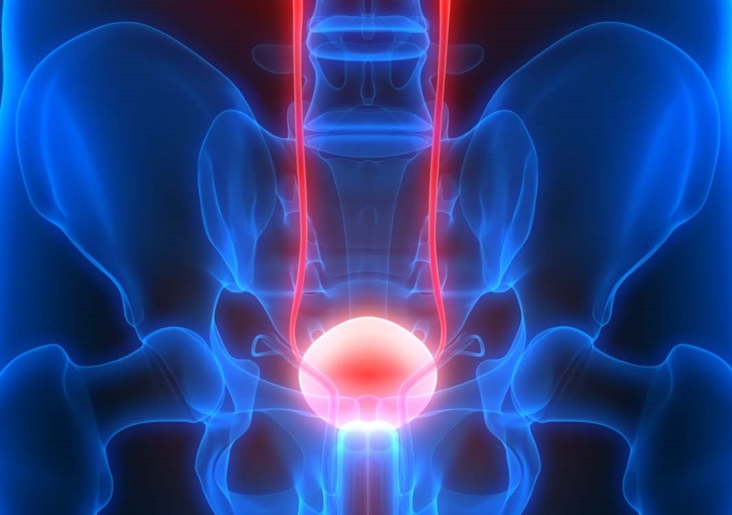 About five and a half million men are diagnosed with bladder cancer every year